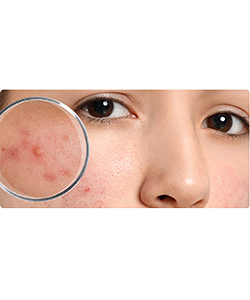 Проблемна шкіра