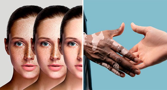 Пигментация: причины возникновения и пути устранения фото