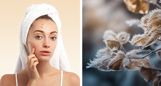 Обострение акне зимой: причини, профилактика и уходовые средства фото