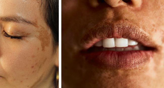 Аптечные средства от пигментных пятен фото