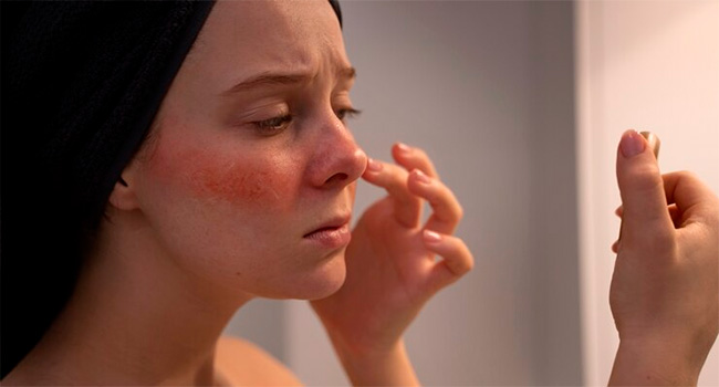 Розацеа: причины и лечение фото