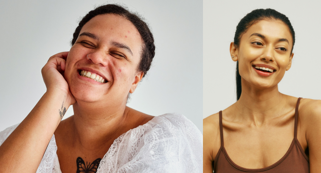 Как избавиться от угрей: советы дерматолога фото