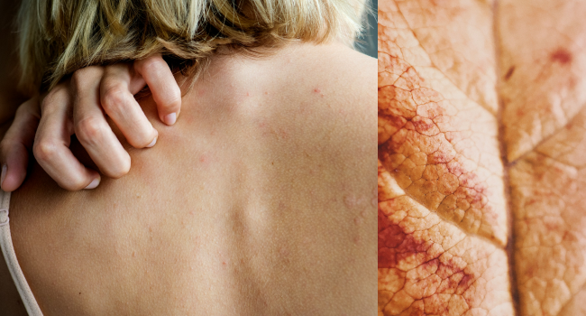 Увлажняющие средства при псориазе фото