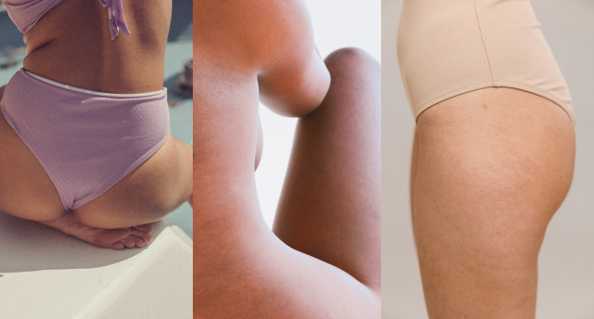 Как убрать растяжки на теле фото